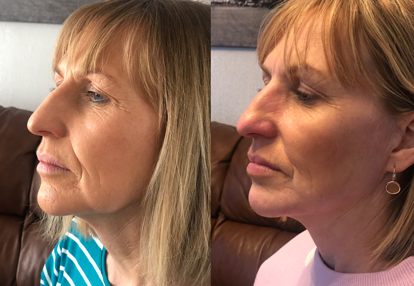 Beautiful woman with soft smooth golden skin after having dermal fillers applied to her face