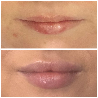 Picture of a beautiful womans pink lips, she has recieved lip filler Juvaderm